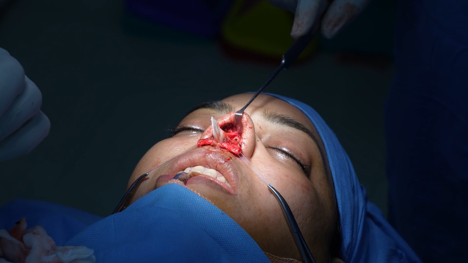 Cosmetic Rhinoplasty